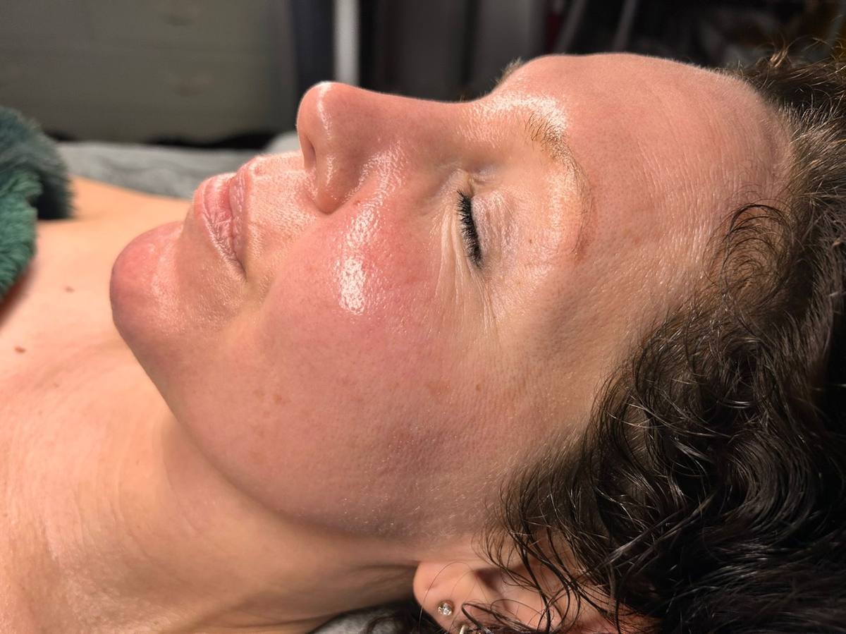 Skin treatment