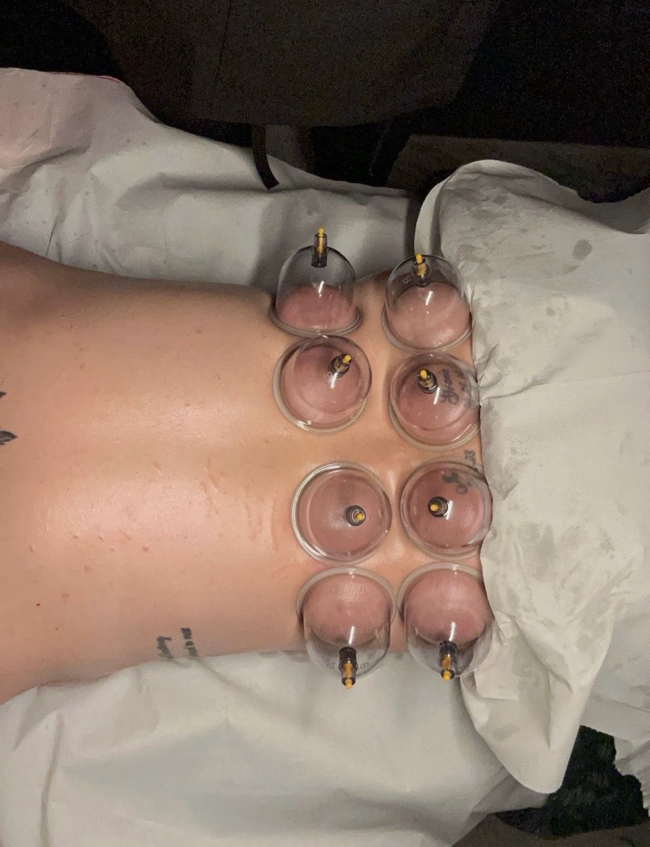 Cupping lower