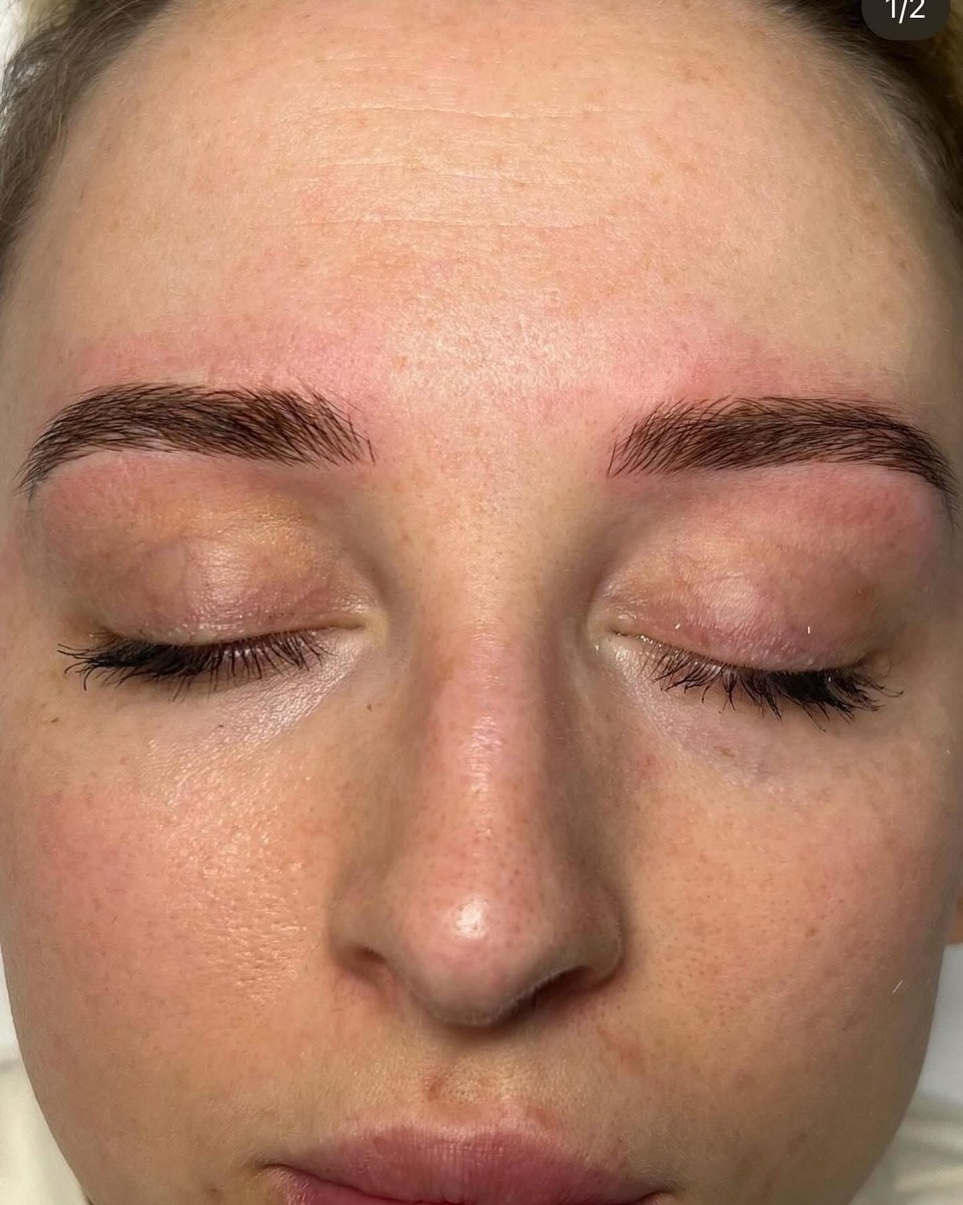 Brow result